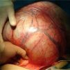 Варненски хирурзи отстраниха 20-килограмов тумор