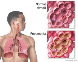 Пневмония. Лечение и симптоми