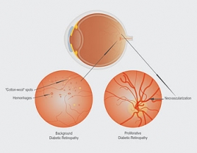 Диабетна ретинопатия 