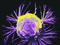 рак, раковите клетки, Супервирус, хистон деацетилаза инхибитори HDAC, рак на гърдата, простатата, дебелото черво