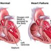 Сърдечна недостатъчност