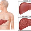 Цироза на черния дроб