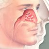 Алергичен ринит ( Allergic Rhinitis ) -  възпаление на носната лигавица