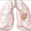 Резултатите от проучването LUME-Lung 1 показаха, че Nintedanib плюс химиотерапия удължава живота на пациентите с рак на белия дроб с аденокарцином