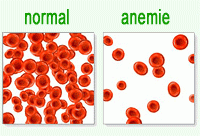 Анемия, анемия симптоми, анемия причини, анемия диагноза,  анемия  лечение, видове анемия