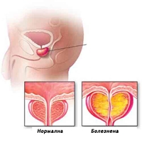 Простатит. Лечение и симптоми