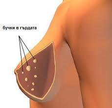 Рак на гърдата. Лечение и симптоми